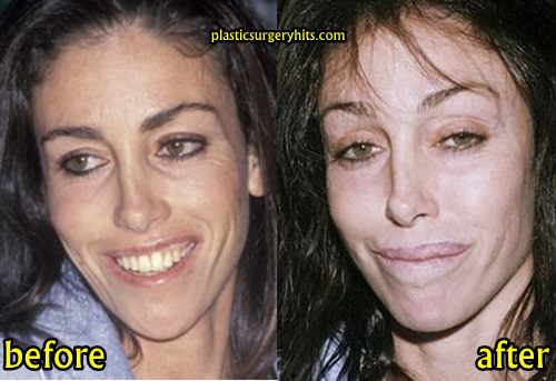 Heidi Fleiss Plastic Surgery Before and After