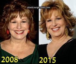 Joy Behar Plastic Surgery Before and After