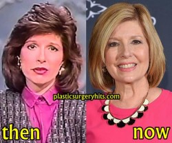 Sandie Rinaldo Plastic Surgery Before and After