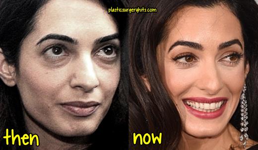 Amal Clooney Plastic Surgery Before and After