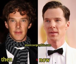 Benedict Cumberbatch Plastic Surgery Fact or Rumor