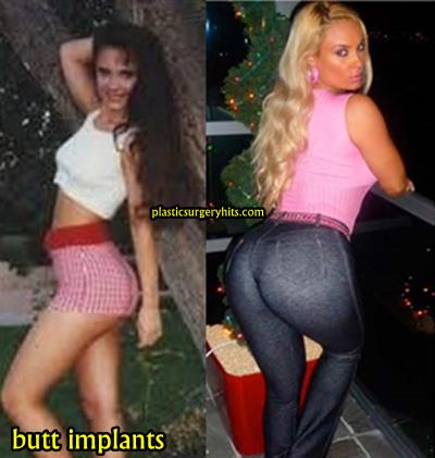 Coco Austin Plastic Surgery Before and After.