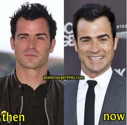 Justin Theroux PLastic Surgery Fact or Rumor