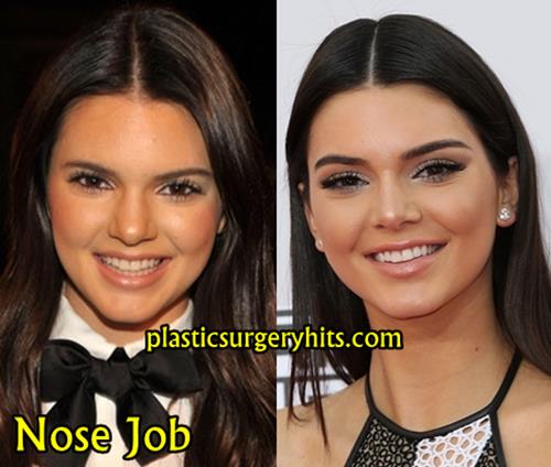 Kendall Jenner Nose Job