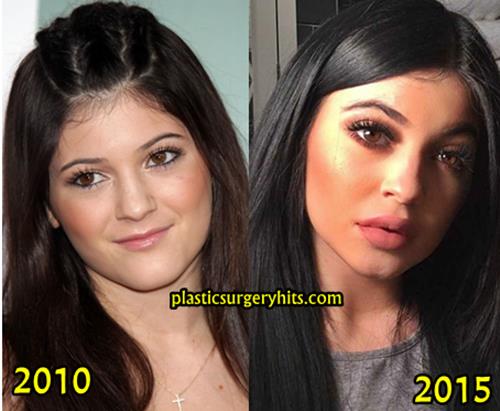 Kylie Jenner Plastic Surgery Before and After