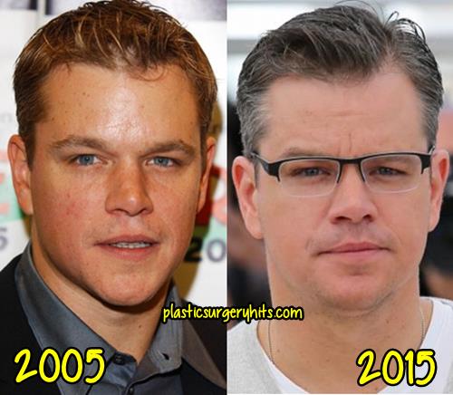 Matt Damon Plastic Surgery fact or Rumor