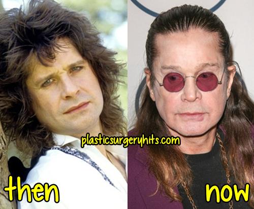 Ozzy Osbourne Plastic Surgery Before and After