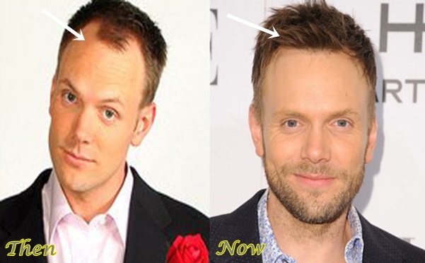 Joel McHale Hair Transplant Before And After Photos - Plastic Surgery Hits.