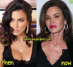 Janice Dickinson Plastic Surgery Before and After