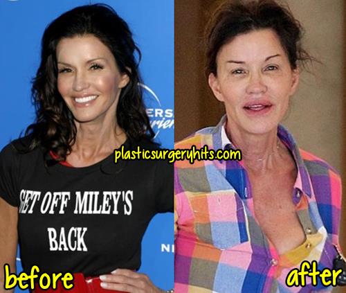 Janice Dickinson Plastic Surgery Gone Wrong