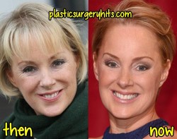 Sally Dynevor Plastic Surgery Before and After