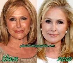 Kathy Hilton Plastic Surgery Before and After