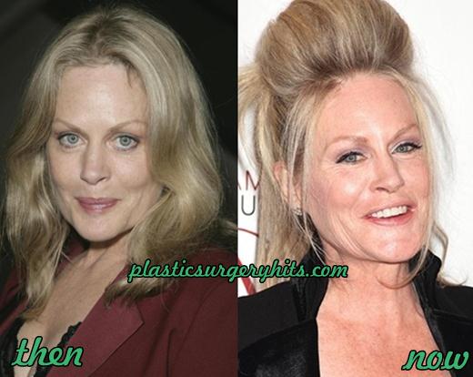 Beverly D'Angelo Plastic Surgery Facelift