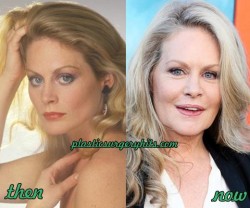 Beverly D'Angelo Plastic Surgery before and After