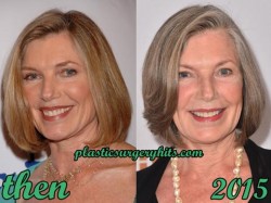 Susan Sullivan Plastic Surgery Before and After